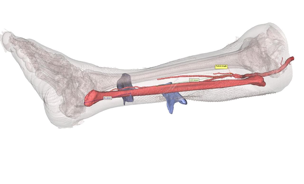 Fibula donor site — left leg