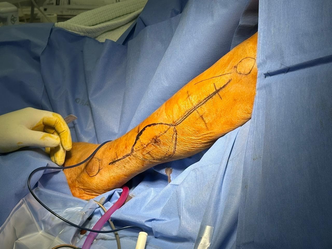 Fibula donor site closure