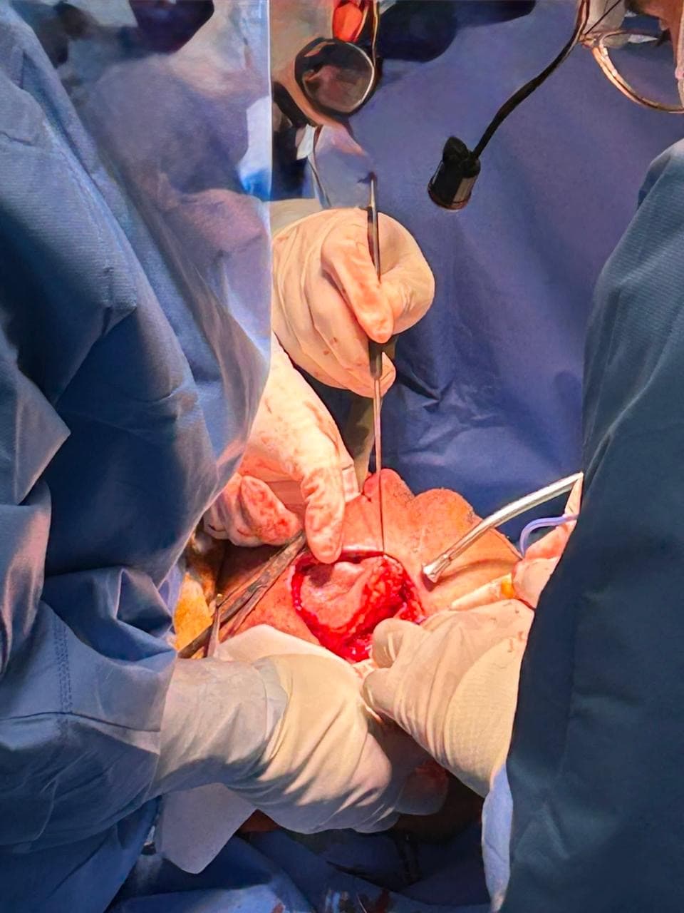 Fibula donor site — left leg