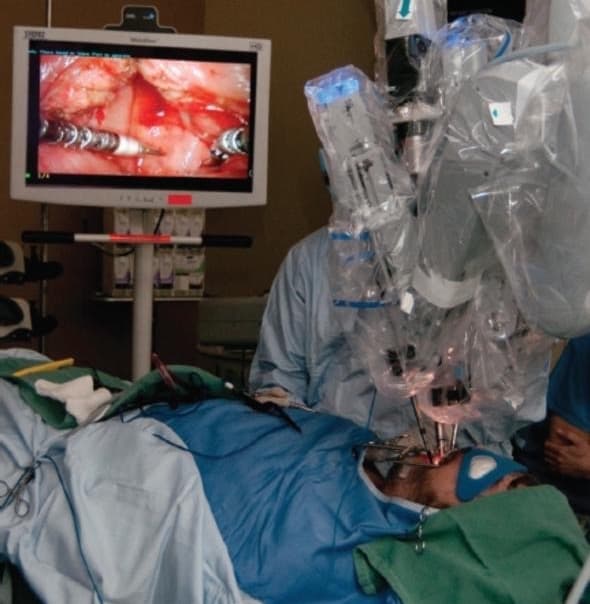 Oropharyngeal Cancer Successfully Treated with Transoral Robotic Surgery (TORS)